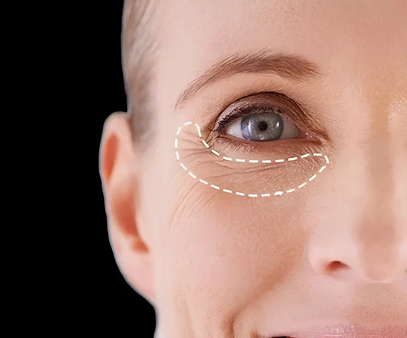 Blépharoplastie en Tunisie